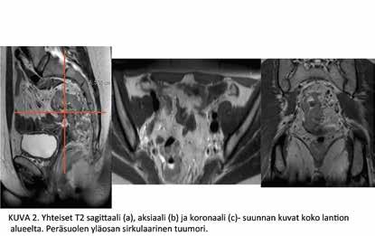 A B C KUVA 2. T2-painotteiset A) sagittaali-, B) aksiaali- ja C) koronaalisuunnan kuvat koko lantion alueelta. Kyseessä on peräsuolen yläosan sirkulaarinen kasvain. 1 mg i.v.) ohutsuolen liikkeen vähentämiseksi.