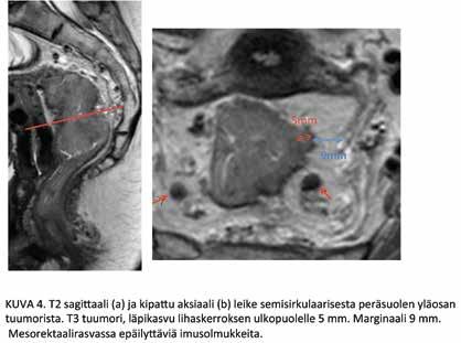 Mesorektaalirasvassa on epäilyttäviä imusolmukkeita (punaiset yksipäiset nuolet).