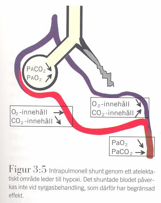 2000 Ventilation-perfusion