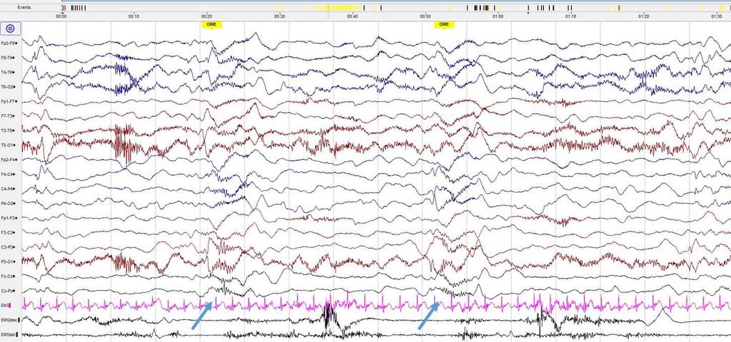 Oheisaineisto 3. Spasmiin liittyvä symmetrinen paroksysmaalisen nopean toiminnan purkaus (nuolet).