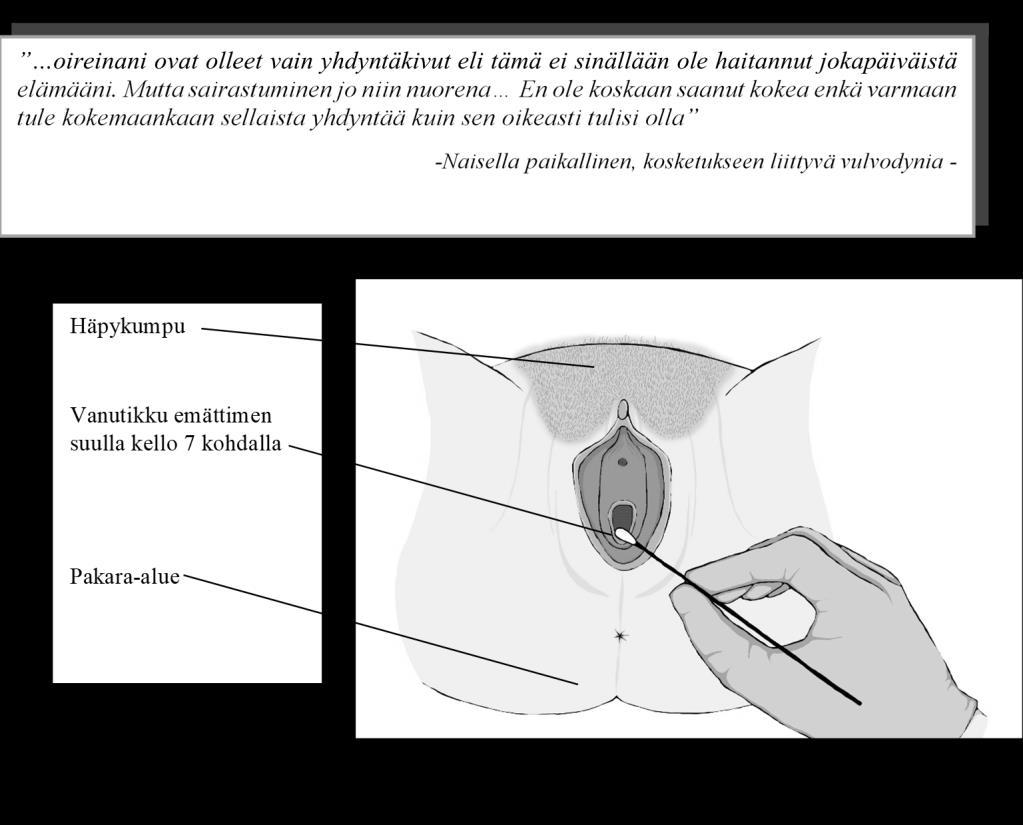 Vulvodynian oireet