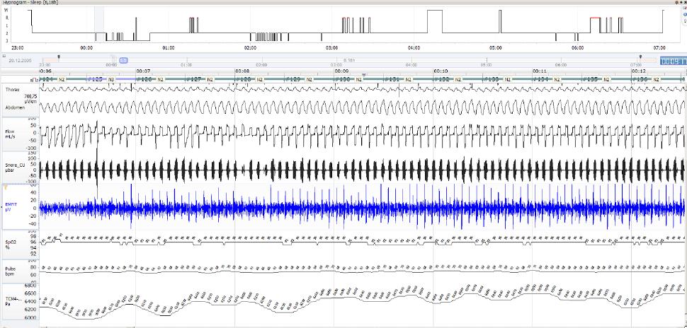 30 Manni R, Zambrelli E, Bellazzi R, Terzaghi M. The relationship between focal seizures and sleep: an analysis of the cyclic alternating pattern. Epilepsy Res 2005;67:73 80.