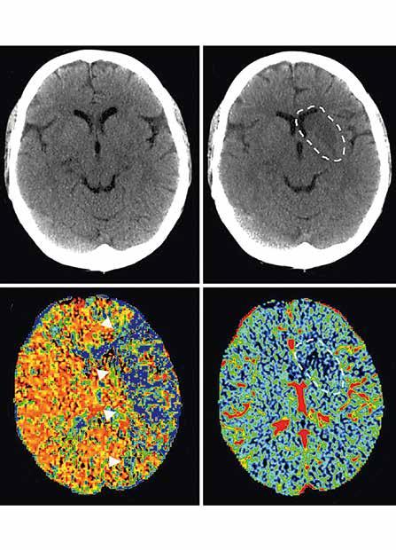 KATSAUS A B C D KUVA 1. Pään natiivi-tt tulovaiheessa (A) ja seurantavaiheessa (B). Perfuusiokuvauksen MTT-kartta osoittaa koko vasemman MCA:n kierron perfuusiohäiriön (C, nuolenpäät).