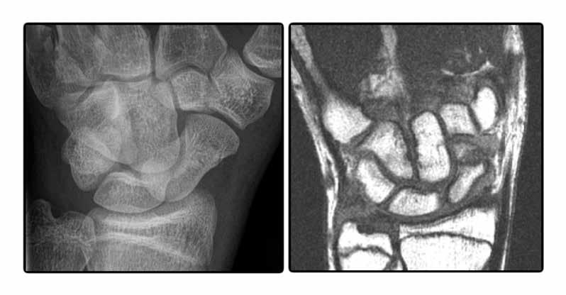 A B KUVA 3. Vaikeasti hahmotettavissa oleva veneluun murtuma: A) natiiviröntgenkuva ja B) sama murtuma magneettikuvassa. Diagnostinen strategia.