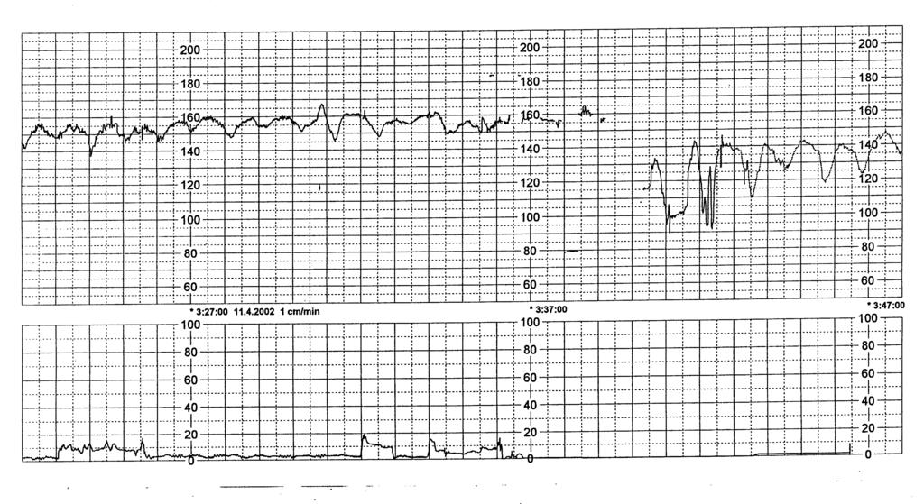 Kuva. Hapenpuutteeseen viittaavia muutoksia sikiön sykekäyrässä ablaation yhteydessä. ten hätätilanne, ja raskaus joudutaan tällöin päättämään keisarileikkauksella sikiön hengen pelastamiseksi.