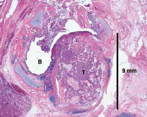 Kuva 3. Tuumori (T) pullistuu polypoidisti bronkuksen luumeniin (B).