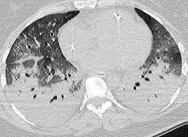 KATSAUS A B C lisen kortikosteroidin lisäksi tulee laukaiseva tekijä eliminoida (INTERNETOHEISAINEISTON TAULUKKO 2). OP:n histologia.