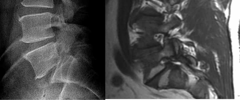 KIPEÄ JALKA L4 L4 L5 L5 A B KUVA 3. A) Sivusuunnan röntgenkuva potilaasta, jolla on spondylolyyttinen presakraalivälin nikamansiirtymä.