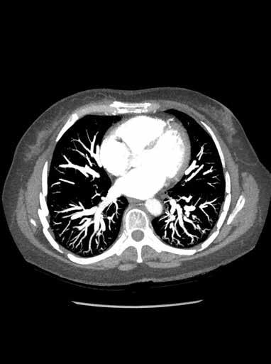 1630 KUVA 2. Työasemalla käsitellyssä varjoainetehosteisessa TT:ssä nähdään keuhkojen ääreisosissa mutkittelevia suonia, jotka ulottuvat tavanomaista perifeerisemmin keuhkojen reuna-alueille.