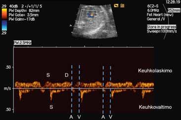 Kuvassa sykedoppler normaalirytmistä keuhkovaltimo- ja -laskimoparista. A = eteissystolen alkukohta, V = kammiosystolen alkukohta, S = systole, D = diastole. ja ulosvirtauskanavaparien virtauksia.