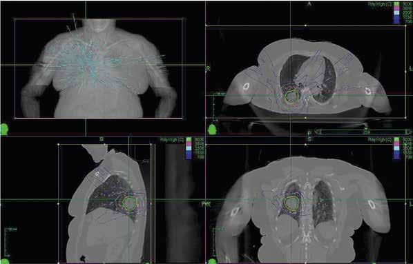 KUVA 2. Potilas sai stereotaktisen sädehoidon Cyberknife-tekniikalla. Yksittäiset säteet kuvaavat hoitokenttien määrää ja suuntaa. Annosjakauma on tarkasti kohteen muotoinen.