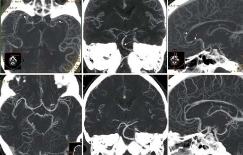 KATSAUS Kuva 1. Reversiibeli aivoverisuonten vasokonstriktio-oireyhtymä 43-vuotiaalla naisella.
