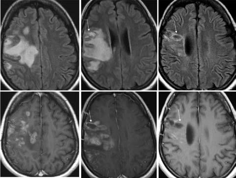 Ahtaumia (nuolet) näkyy keskimmäisen aivovaltimon (kuvapari oikealla), etummaisen aivovaltimon (kuvapari vasemmalla) ja kallonpohjavaltimon (kuvapari keskellä) alueilla.