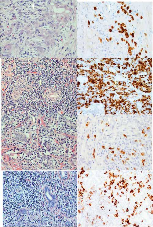 A1 A2 B1 B2 C1 C2 D1 D2 KUVA 3. IgG4-sairauden histologiaa ja immunohistokemiaa. A1 ja B2: Autoimmuunipankreatiitti 48-vuotiaalla miehellä.