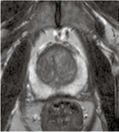 x A B C KUVA 2. A ja B) Eturauhasen anatomia aksiaalisuuunnan T2-painotteisessa MK:ssa. Eturauhasta reunustaa kapselimainen sidekudoskerros, joka näkyy MK:ssa niukkasignaalisena rajapintana.