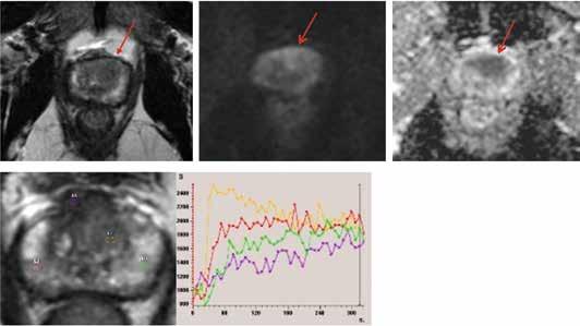 A B diffuusio b800 C ADC 400 cm2/s D KUVA 7. 55-vuotiaan miehen PSA-arvo oli 28 µg/l, ja biopsiassa Gleasonin 6 pisteen löydös vasemmasta tyviosasta.