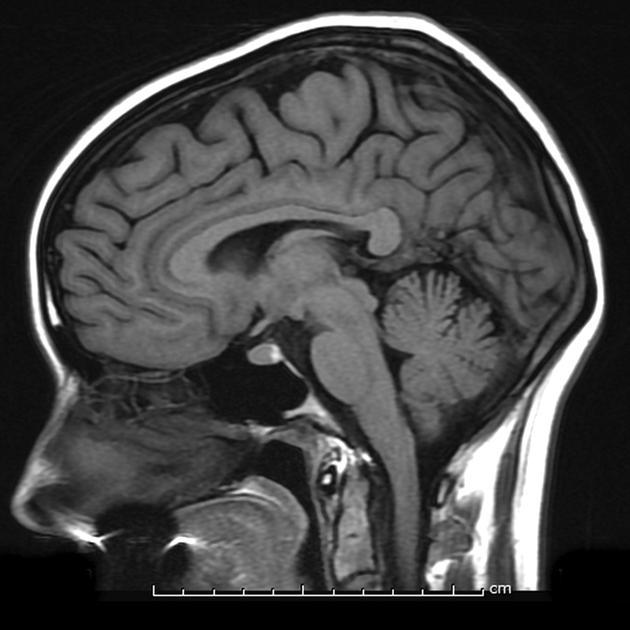 ALZHEIMERIN DEMENTIAN VARHAINEN TUNNISTAMINEN yleisesti: computer-aided diagnosis / prediction = kuvantaminen / mittaaminen + koneoppimismenetelmät AD ennustaminen aivokuvista ehkä kuumin aihe tällä