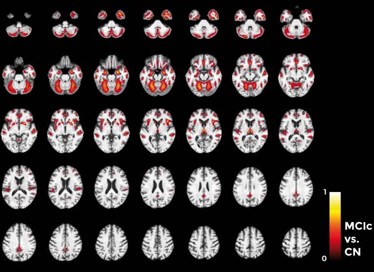 ALZHEIMERIN DEMENTIAN VARHAINEN