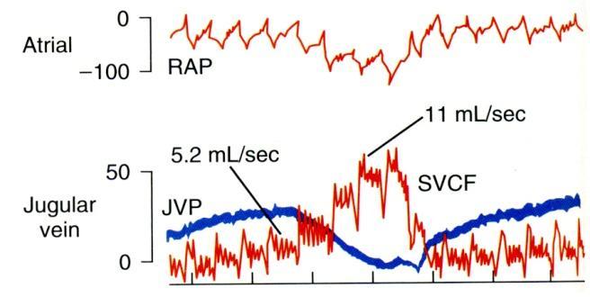 Hengityspumppu Sekä rintakehän sisäinen paine, oikean eteisen paine (RAP) että kaulalaskimon paine (JVP) laskevat normaalin