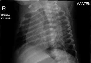kylkiluiden viistoprojektiossa tuoreet murtumat (nuolet) vasemmalla kylkiluissa 6 7 ja C) kahta viikkoa myöhemmin otetussa thorax-kuvassa selvää uudisluuta kylkiluissa 5 9 vasemmalla takana keskellä.