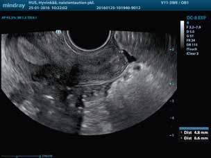 PÄIVYSTÄJÄN KAIKUKUVAUS KUVA 3. Fysiologinen määrä nestettä fossa Douglasissa. KUVA 4. Endometriumin mittaaminen, normaali endometrium on fertiili-ikäisillä enintään 16 mm. KUVA 5. Munapussi. KUVA 6.