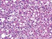 A B KUVA 3. A. Histologisesti SDHBmutaatioon liittyvä munuaiskarsinooma muistuttaa onkosyyttistä tuumoria, mutta sytoplasma värjäytyy vaaleammin ja sisältää vakuolimaisia inkluusioita. B. SDHB puuttuu kasvainsoluista ja on nähtävissä vain verisuonten seinämissä.