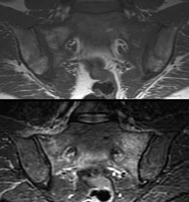T1- (yllä) ja T2-painotteisissa rasvasuppressiokuvissa (keskellä) sekä natiiviröntgenkuvassa nähdään iliumiin painottuva voimakasasteinen