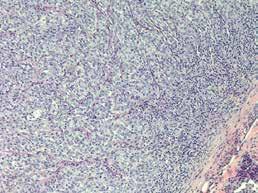 A B Kuva 2. A) Kaulan alueelta poistettu suurentunut imusolmuke, jossa todetaan huonosti erilaistunutta kasvainsolukkoa.
