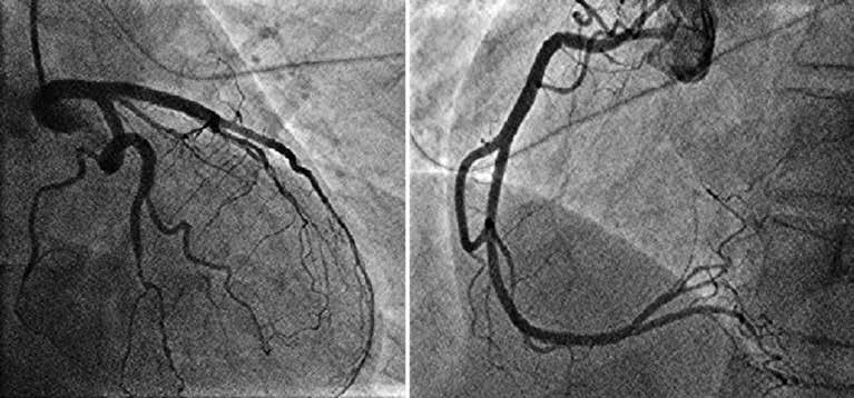 A B KUVA 1. A) Tulovaiheessa otettu 12-kanavainen EKG (50 mm/s). Lievää ST-tason laskua on nähtävillä anteriorisissa rintakytkennöissä. B) 12-kanavainen EKG (50 mm/s) 30 minuuttia myöhemmin.