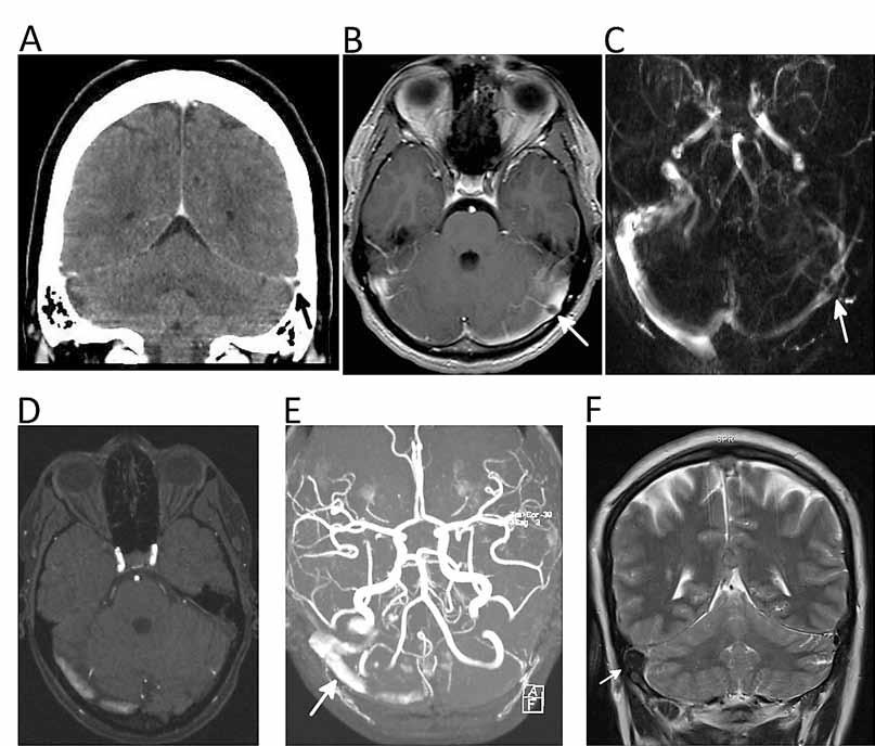 A B C D E F Kuva 4. Sinustromboosin MK-diagnostiikassa on useita huomioitavia sudenkuoppia.