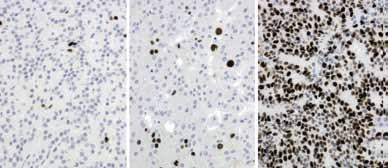 A B C Kuva 1. Immunohistokemiallinen Ki-67-värjäys MIB-1-vasta-aineella kolmesta eri neuroendokriinisesta kasvaimesta.