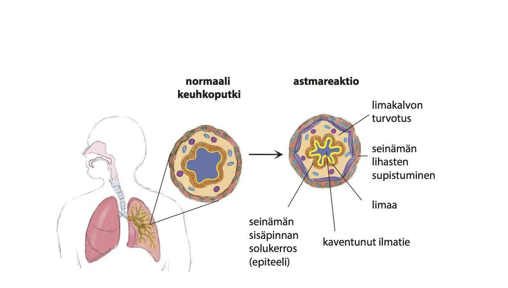 Kaavakuva astmareaktiosta keuhkoputkessa