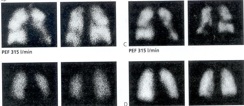 Astma, bronkodilataatio VENTILAATIO, Kr-81m PERFUUSIO, Tc-99m-MAA ap pa ap pa PEF 315 l/min
