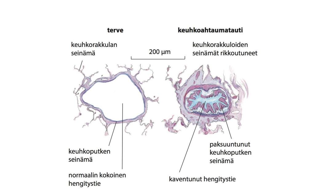 Ahtautunut pieni keuhkoputki COPD:ssä Mukailtu lähteestä Hansel ja