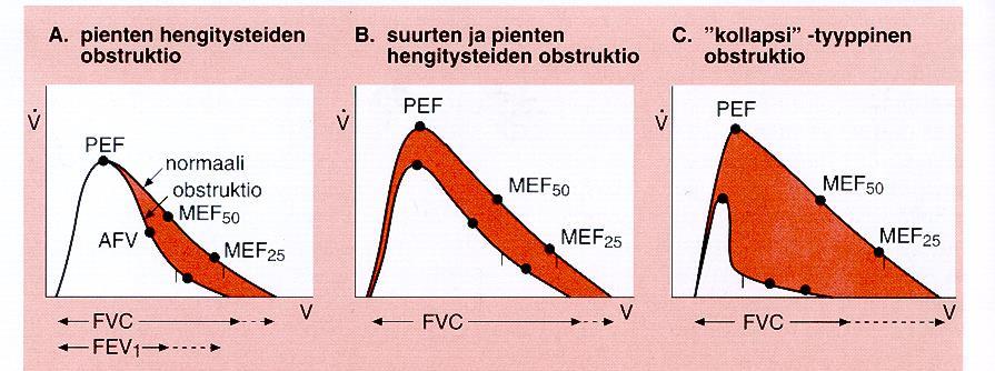 Spirometriakäyrien tulkintaa