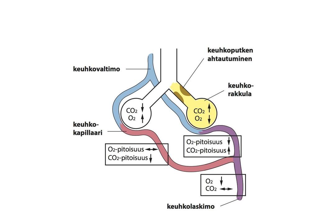 COPD ja astma: Epätasainen keuhkotuuletus hypoksemia