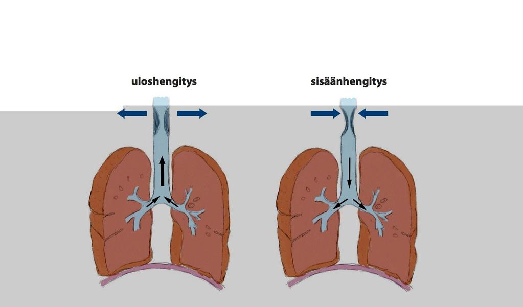 Sisäänhengitysvirtauksen rajoittuminen äänihuulihalvauksessa tai -salpauksessa