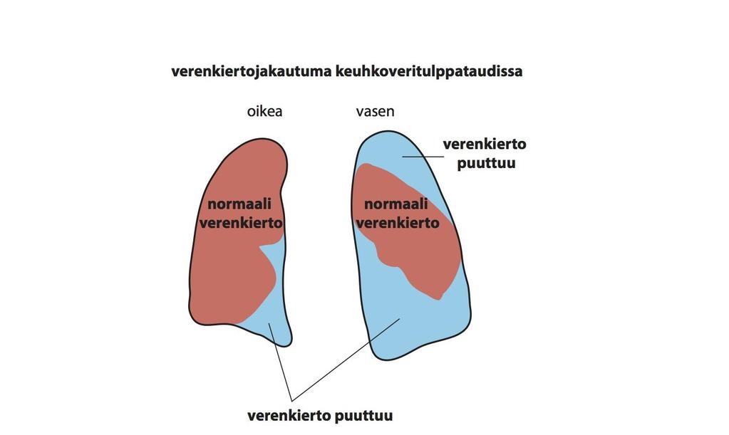 Keuhkoveritulppa eli keuhkoembolia Kirjassa