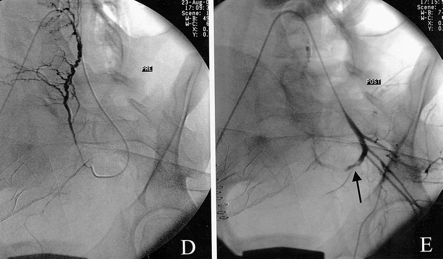 D) Selektiivisessä varjoaineruiskutuksessa vasempaan kohtuvaltimoon ei todeta ekstravasaatiota. E) Vasen kohtuvaltimokin emboloidaan, ja angiografiassa suoni on tukossa proksimaaliosaansa asti.