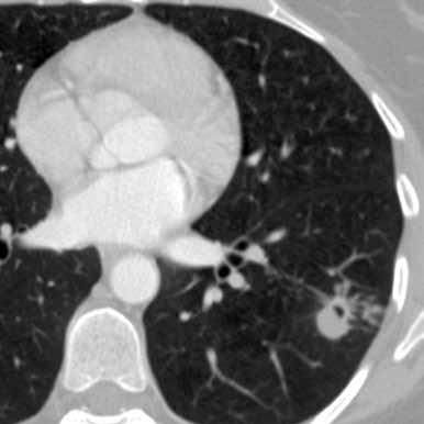 Koska sairauskertomusten tai diagnoositietojen perusteella mahdollista tartuttajaa ei löytynyt, HUS:n epidemiologinen yksikkö pyysi patologian osastoa selvittämään ruumiinavaukset, jotka olivat