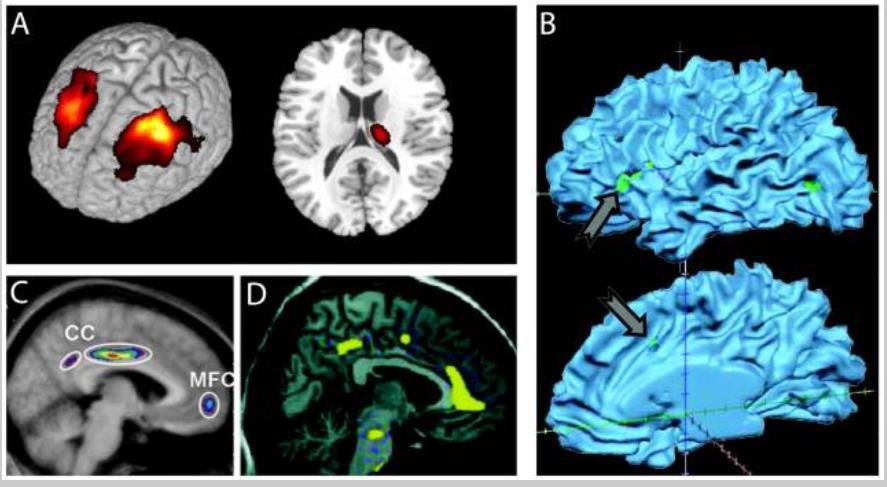 Pain and the brain: Specificity and plasticity of the brain in clinical chronic pain Apkarian Pain. 2011 Mar; 152(3 Suppl): S49 S64 A. Krooninen selkäkipu: prefrontaalinen cortex, thalamus B.