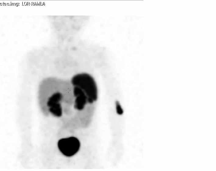 KUVA 3. Kahden vuoden ja kuukauden ikäinen potilas, jolla on tason IV neuroblastooma. Emokasvain oli oikeassa lisämunuaisessa ja kasvoi maksan kapselin läpi.