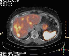 KATSAUS A B KUVA 4. Potilaalla on NET:n etäpesäkkeitä maksassa. Hän on saanut neljästi lutetium- oktreo taattihoitoa, hän voi hyvin, ja magneettikuvauksessa on havaittu suotuisa vaste.