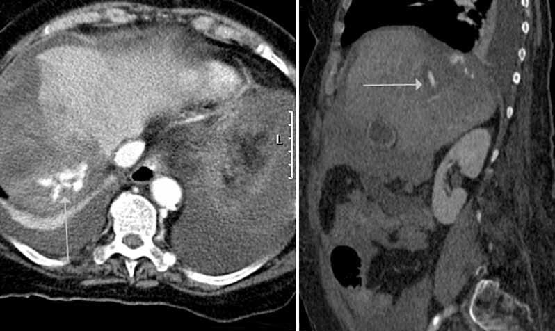 TOIMENPIDERADIOLOGIA A B C D Kuva 1. Moottoripyöräilijä on saanut ulosajon seurauksena maksanrepeämän.