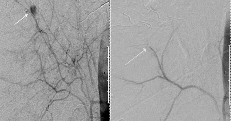 C) Angiografia osoittaa selvästi varjoaineen lammikoitumisen verenvuodon merkkinä. D) Partikkeleilla suoritetun embolisaation jälkeen vuotanut suoni on tukossa.