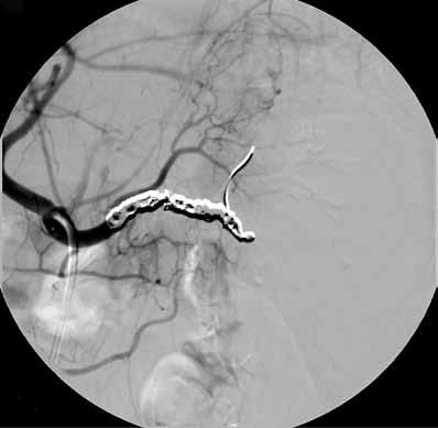 Metallikoilit ovat suositeltavin embolisaatiomateraali. Proksimaalisesssa embolisaatiossa pernavaltimo tukitaan arteria pancreatica dorsaliksen lähtökohdan distaalipuolelta (KUVA 2D).