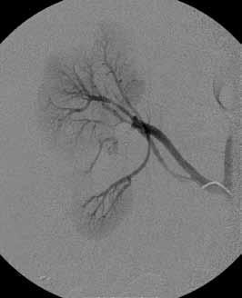 uusinta-angiografiassa. G) Munuaisvaltimo on emboloitu tukkoon Gelfoamilla.