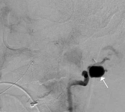 TOIMENPIDERADIOLOGIA A B C Kuva 5. Kaulaan puukotetulla poliisilla epäiltiin kaulavaltimon vammaa, jota ei leikkauksessa löytynyt. A) Angiografia osoittaa vasemman nikamavaltimon vuodon.