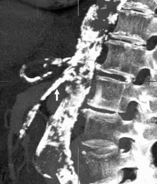 TOIMENPIDERADIOLOGIA Hoito Mesenteriaali-iskemian hoidosta on suhteellisen vähän julkaisuja eikä eteneviä tai satunnaistettuja tutkimuksia