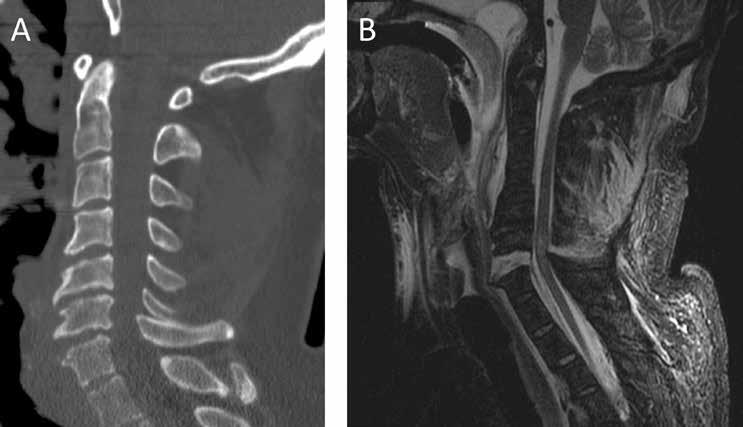 KUVA 1. Traumaattinen retrolisteesivamma on salakavala ligamenttivamma, joka usein on itsekseen reponoitunut hyvään asentoon ja siksi vaikeasti havaittavissa röntgen- ja TT-kuvissa.